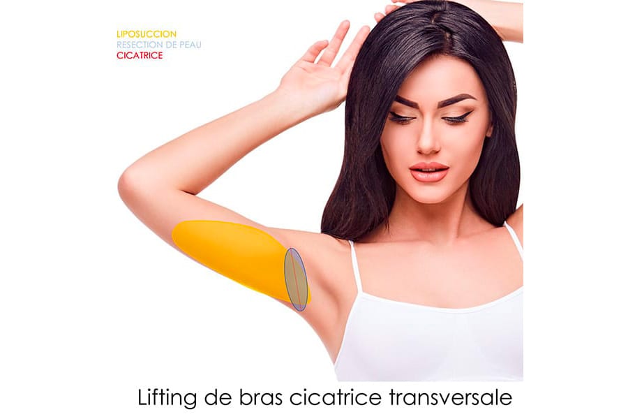 liposuccion HD chirurgie silhouette chirurgie esthetique paris dr philippe pelissier chirurgien plasticien esthetique paris