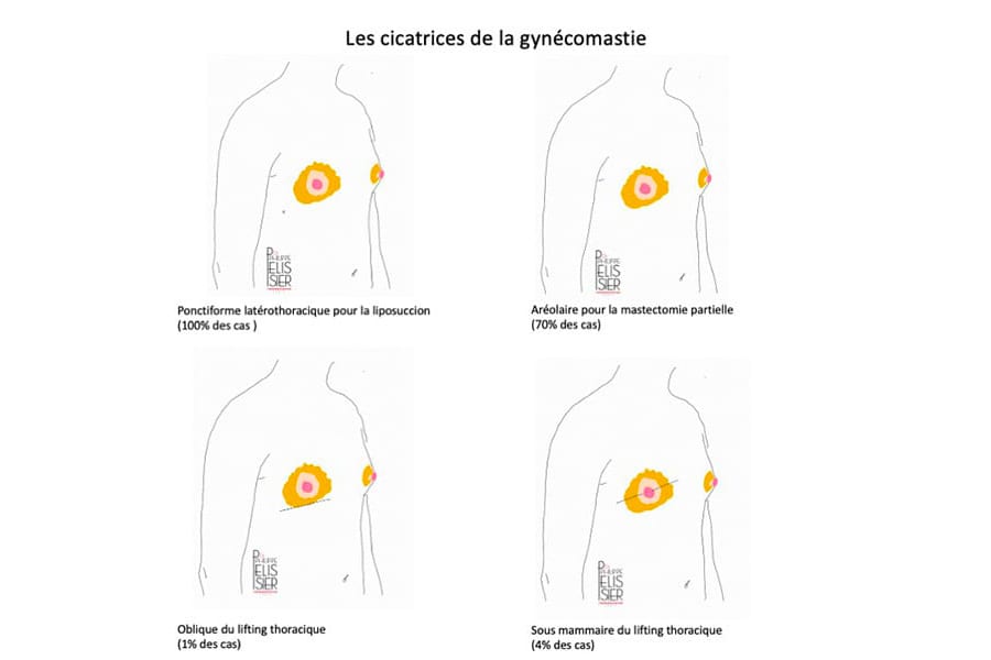 liposuccion HD chirurgie silhouette chirurgie esthetique paris dr philippe pelissier chirurgien plasticien esthetique paris