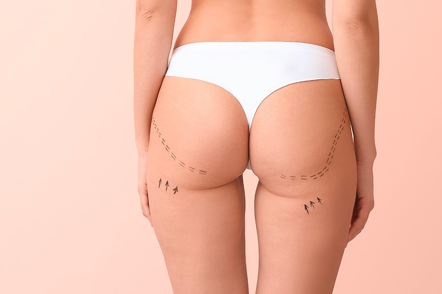 liposuccion HD chirurgie silhouette chirurgie esthetique paris dr philippe pelissier chirurgien plasticien esthetique paris