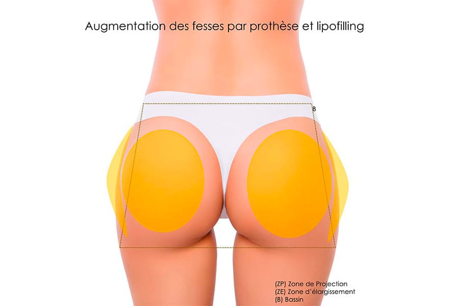liposuccion HD chirurgie silhouette chirurgie esthetique paris dr philippe pelissier chirurgien plasticien esthetique paris