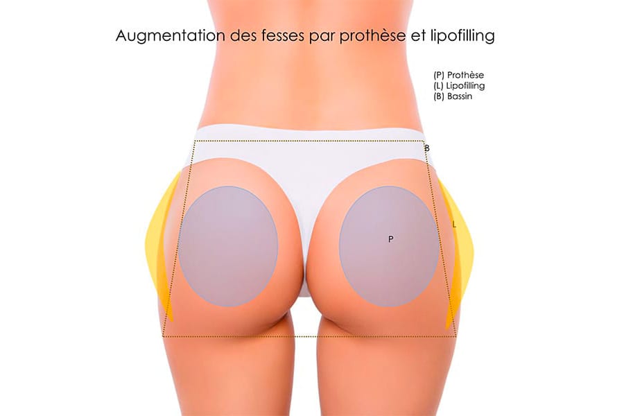 liposuccion HD chirurgie silhouette chirurgie esthetique paris dr philippe pelissier chirurgien plasticien esthetique paris