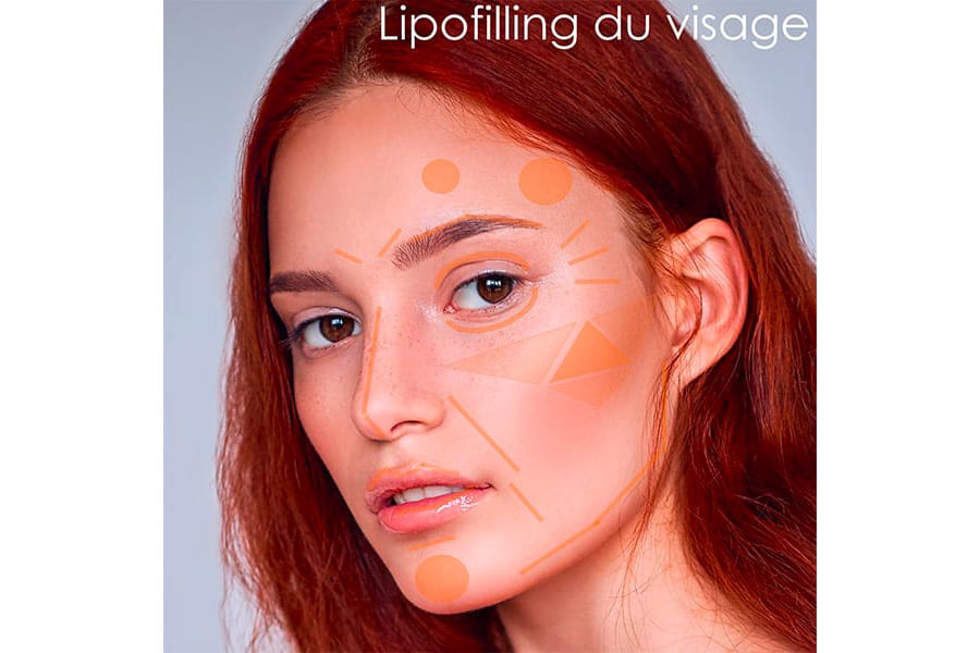 liposuccion HD chirurgie silhouette chirurgie esthetique paris dr philippe pelissier chirurgien plasticien esthetique paris