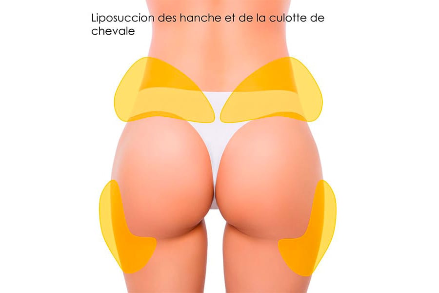 liposuccion HD chirurgie silhouette chirurgie esthetique paris dr philippe pelissier chirurgien plasticien esthetique paris