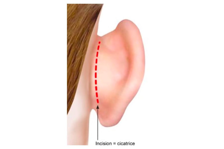 liposuccion HD chirurgie silhouette chirurgie esthetique paris dr philippe pelissier chirurgien plasticien esthetique paris