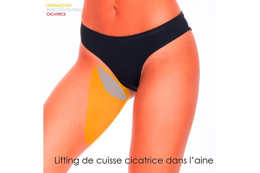 liposuccion HD chirurgie silhouette chirurgie esthetique paris dr philippe pelissier chirurgien plasticien esthetique paris