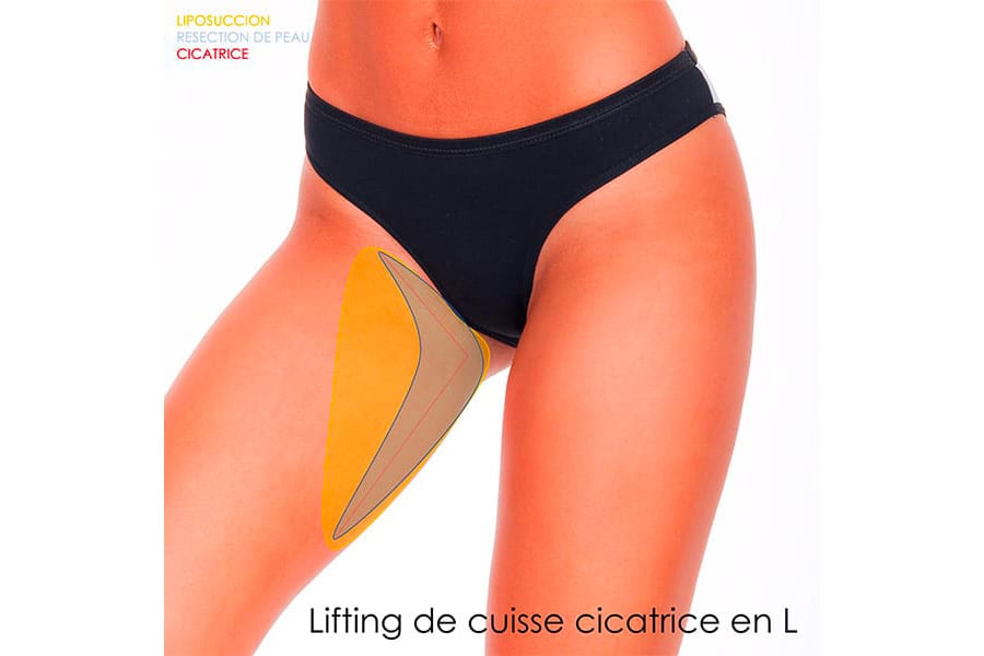 liposuccion HD chirurgie silhouette chirurgie esthetique paris dr philippe pelissier chirurgien plasticien esthetique paris